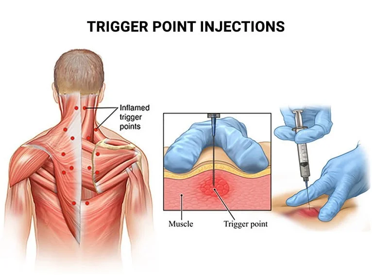 Kỹ thuật châm kim khô Dry Needling và tiêm Trigger Point cơ thang điều trị đau cổ vai gáy