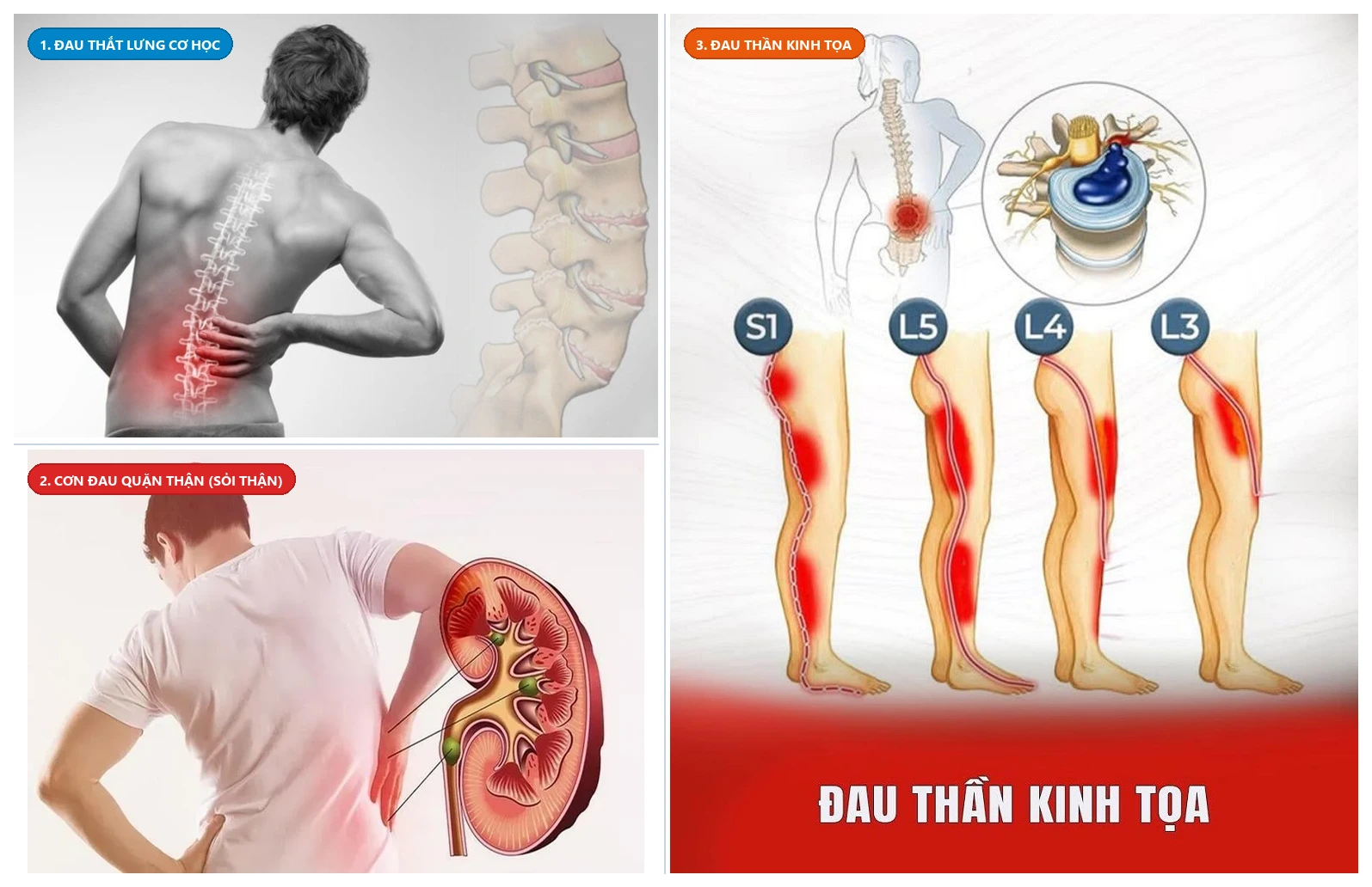 Đối chứng lâm sàng phân biệt Đau thắt lưng cơ học vs Cơn đau quặn thận vs Đau thần kinh tọa